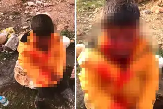 9 Yaşındaki Çocuğa Kuduz Köpek Saldırısı!